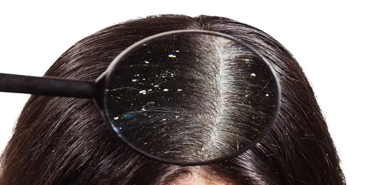 Dandruff-Image.webp