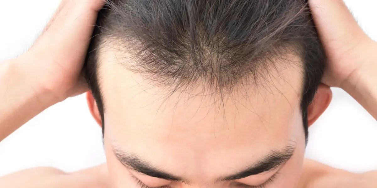 Hairfall-tiny-1.webp