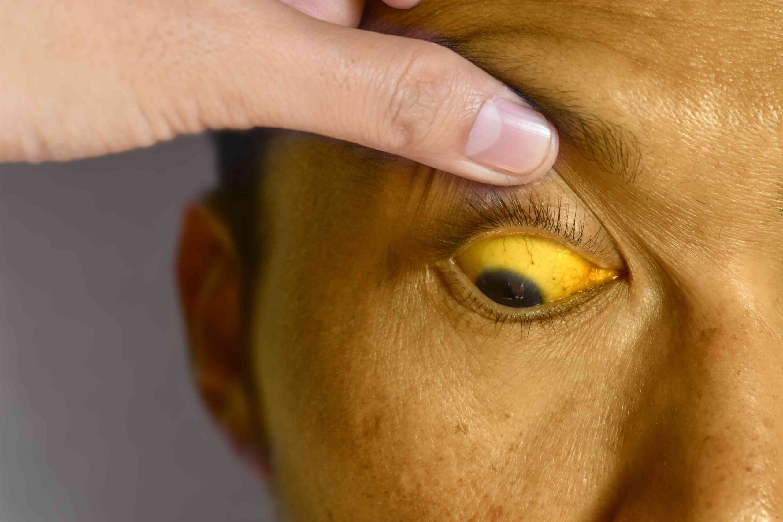 Homeopathic Treatment for Jaundice