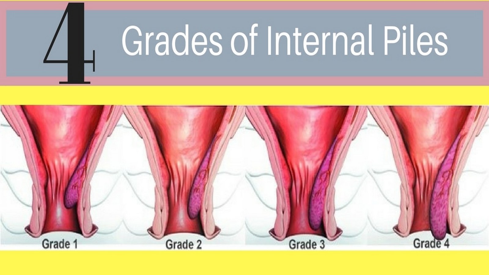 Best Homeopathic Treatment for Piles