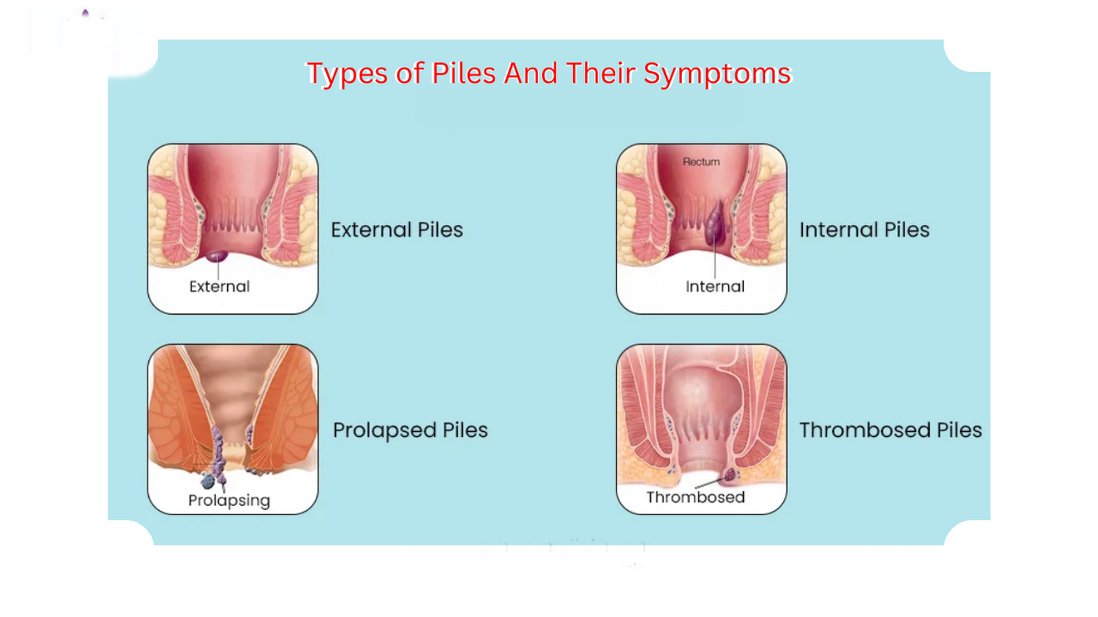 Best Homeopathic Doctor for Piles